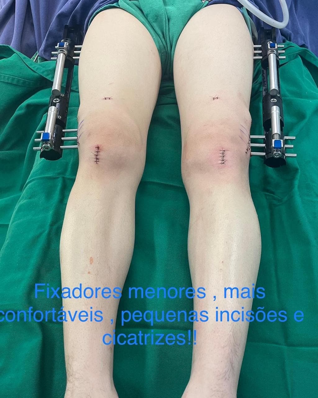 Momento final da cirurgia de alongamento ósseo — identidade preservada.