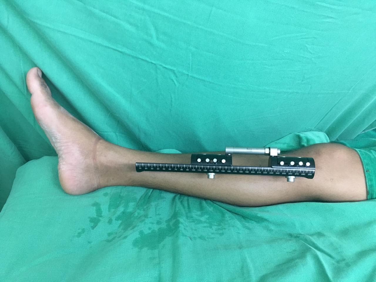 Paciente em repouso após cirurgia na tíbia — identidade preservada.