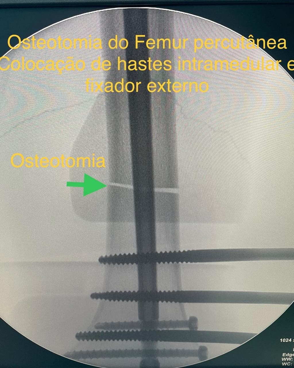 Raio-X pós-operatório mostrando a haste intramedular Fitbone posicionada.