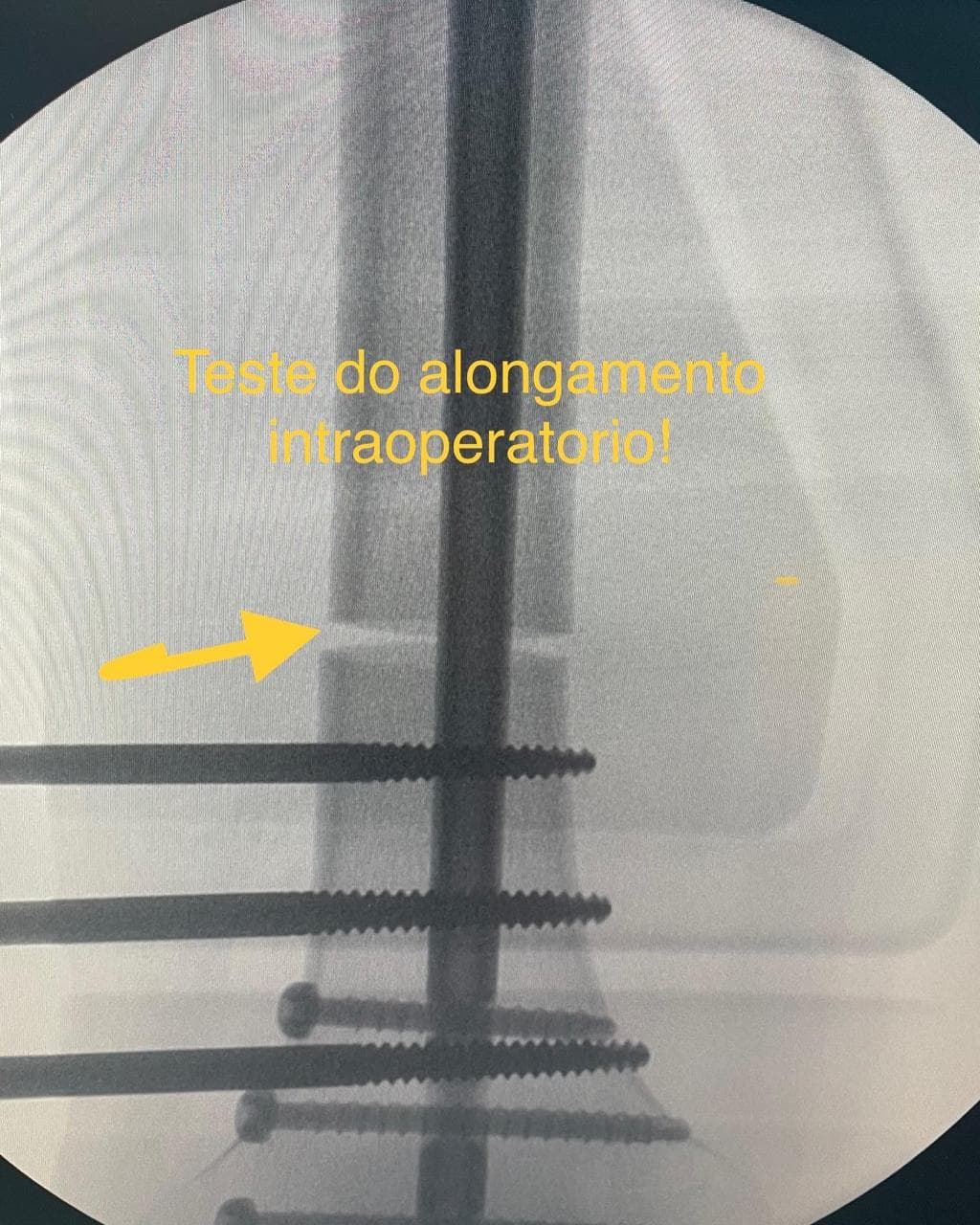 Raio-X intermediário acompanhando a evolução do alongamento ósseo.