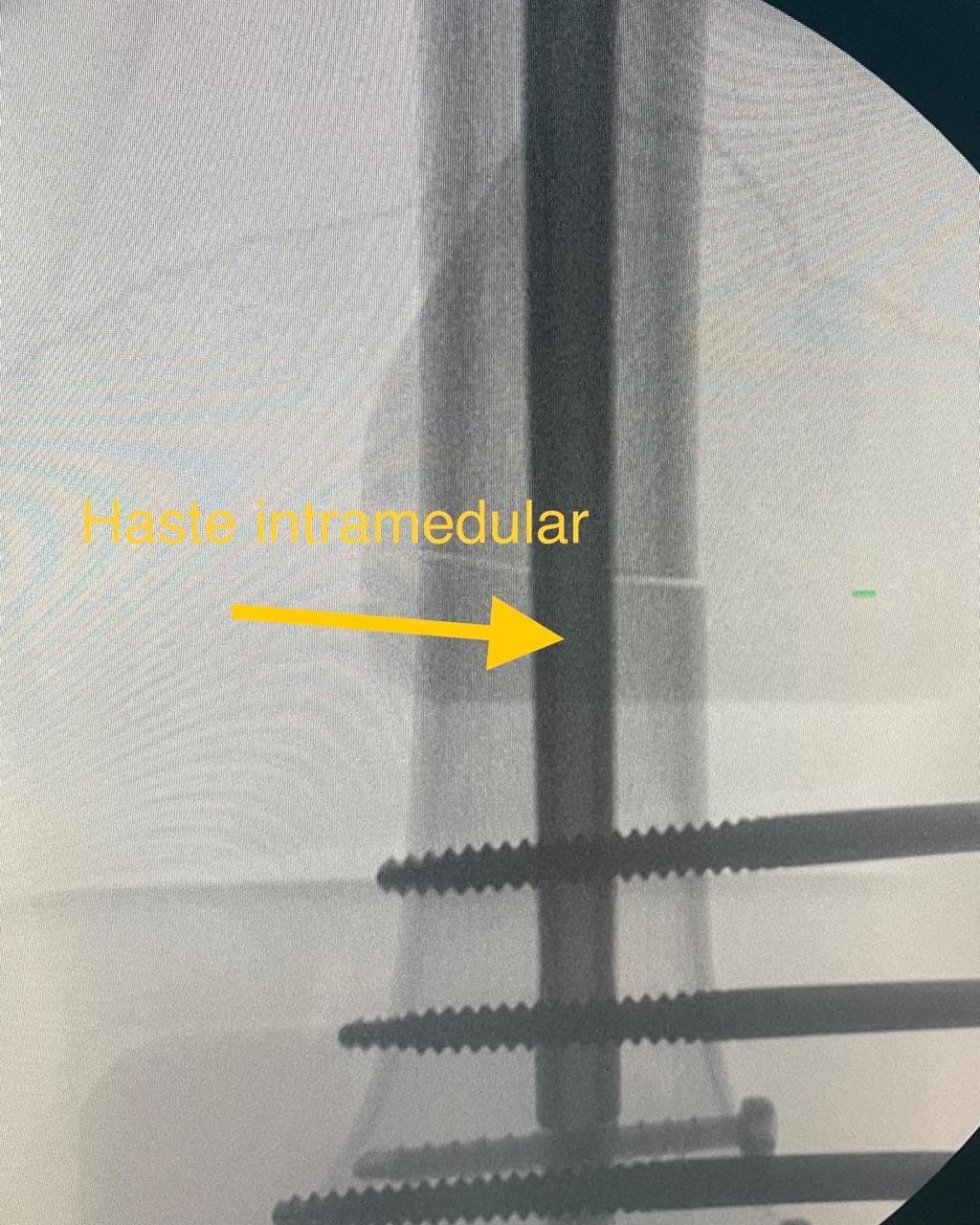 Raio-X documentando a consolidação óssea após o alongamento.